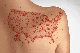 Measles rash in USA shape