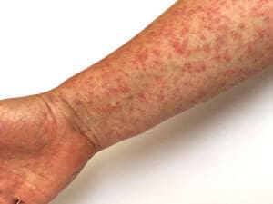 measles on arm