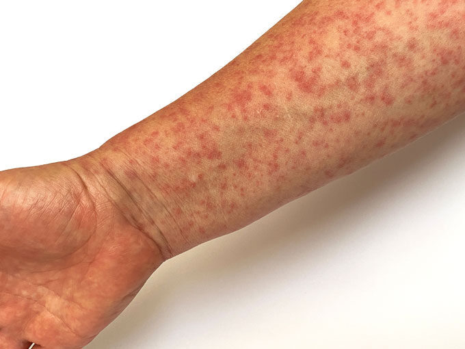 measles on arm